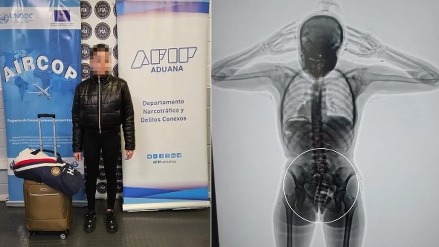 Jovem Presa Ap S Ser Flagrada Em Aeroporto C Psulas Coca Na Na Vagina E Outras