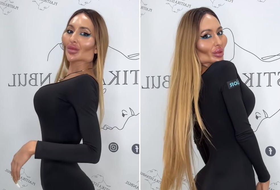 Modelo ucraniana Anastasiia Pokreshchuk completa 10 anos de preenchimentos que a deixaram com as maiores maçãs do rosto no mundo — Foto: Reprodução/Instagram