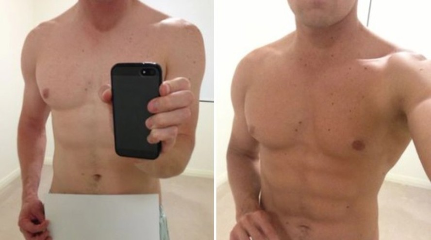 melanotan 2 antes e depois Paciente tem ereção indesejada de 30 horas após usar 'droga da Barbie'