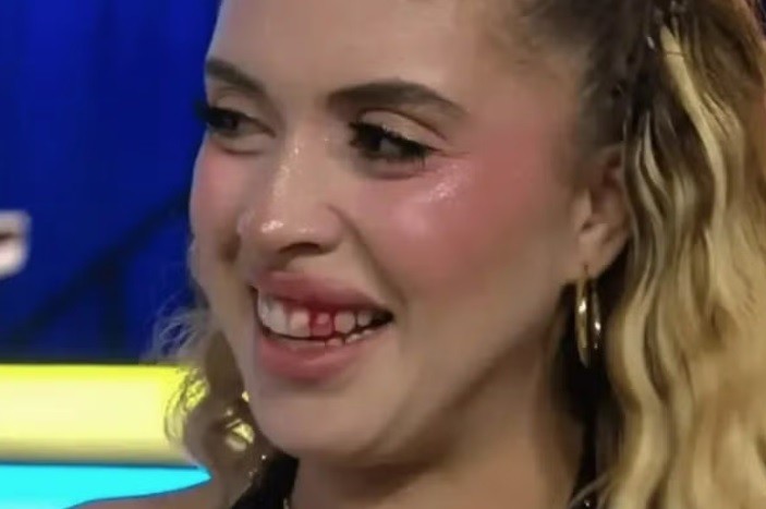 Modelo atingida por drone chutado por apresentador de programa de TV precisará de tratamento odontológico