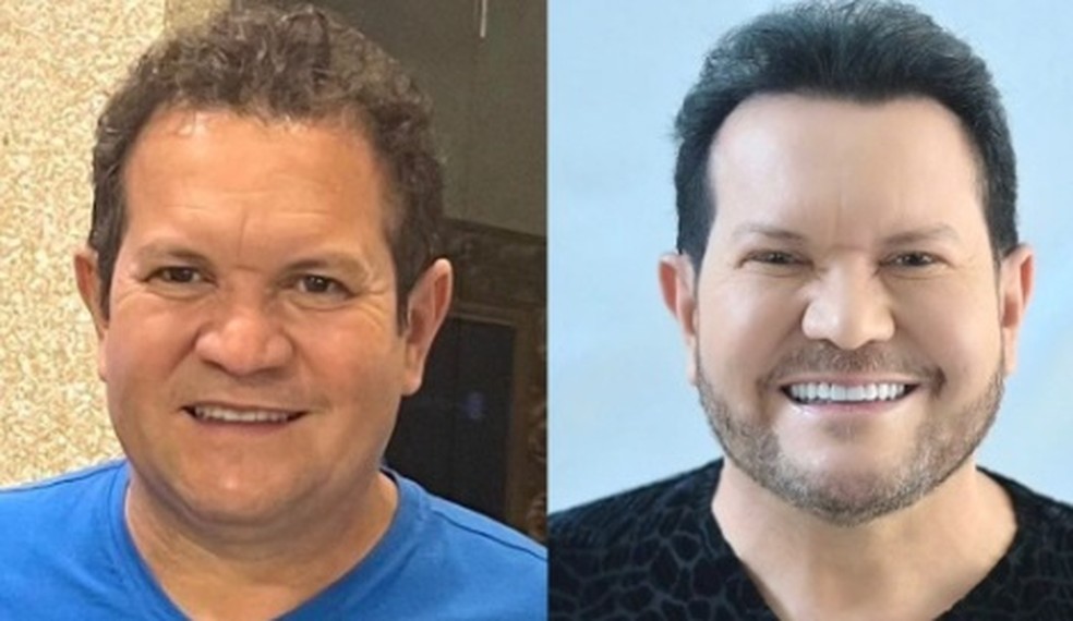 Ximbinha faz nova harmonização facial e exibe resultado — Foto: Instagram
