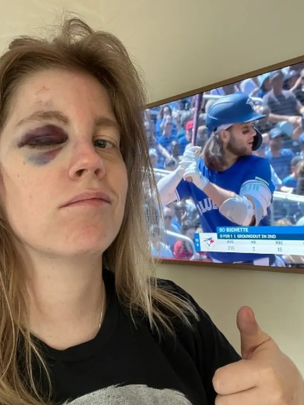 Liz McGuire após ser atingida no rosto por bola de beisebol — Foto: Reprodução/X