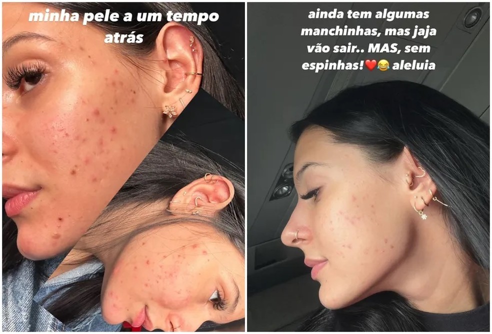 Ana Castela fez tratamento em 2024 para reduzir espinhas &mdash; Foto: Reprodu&ccedil;&atilde;o/Instagram