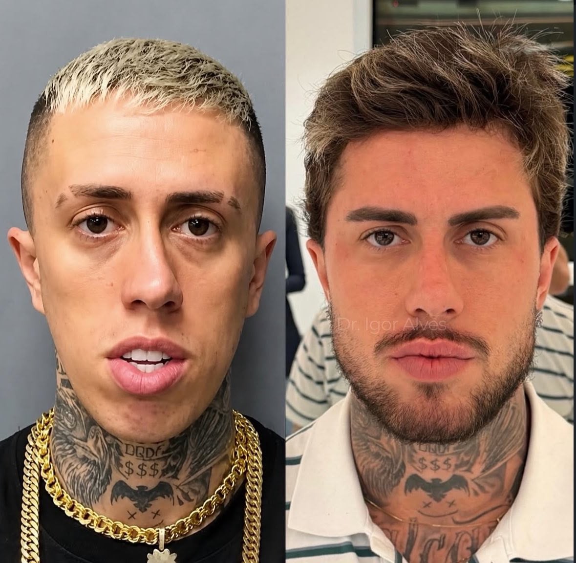 MC Daniel antes e depois dos procedimentos estéticos
