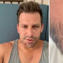 Mandíbula e machucados de Henri Castelli após agressões — Foto: Reprodução/Instagram