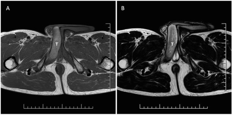 Exames mostraram co&aacute;gulo de 18 mil&iacute;metros no &oacute;rg&atilde;o do maratonista
