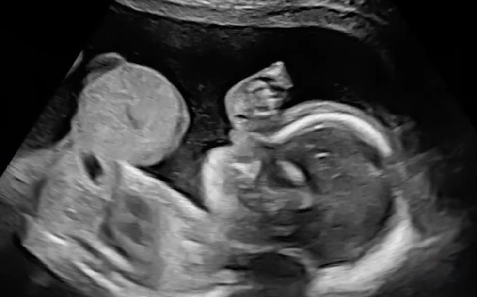 Riley Alaya, m&atilde;e de Hendrix, descobriu a onfalocele do filho durante o segundo trimestre da gravidez &mdash; Foto: Reprodu&ccedil;&atilde;o / MercyOne Des Moines