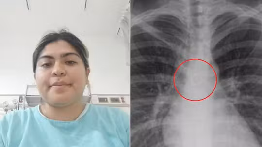 Mulher descobre que piercing no nariz que havia sumido estava alojado nos pulmões Mulher descobre que piercing no nariz que havia sumido estava alojado nos pulmões