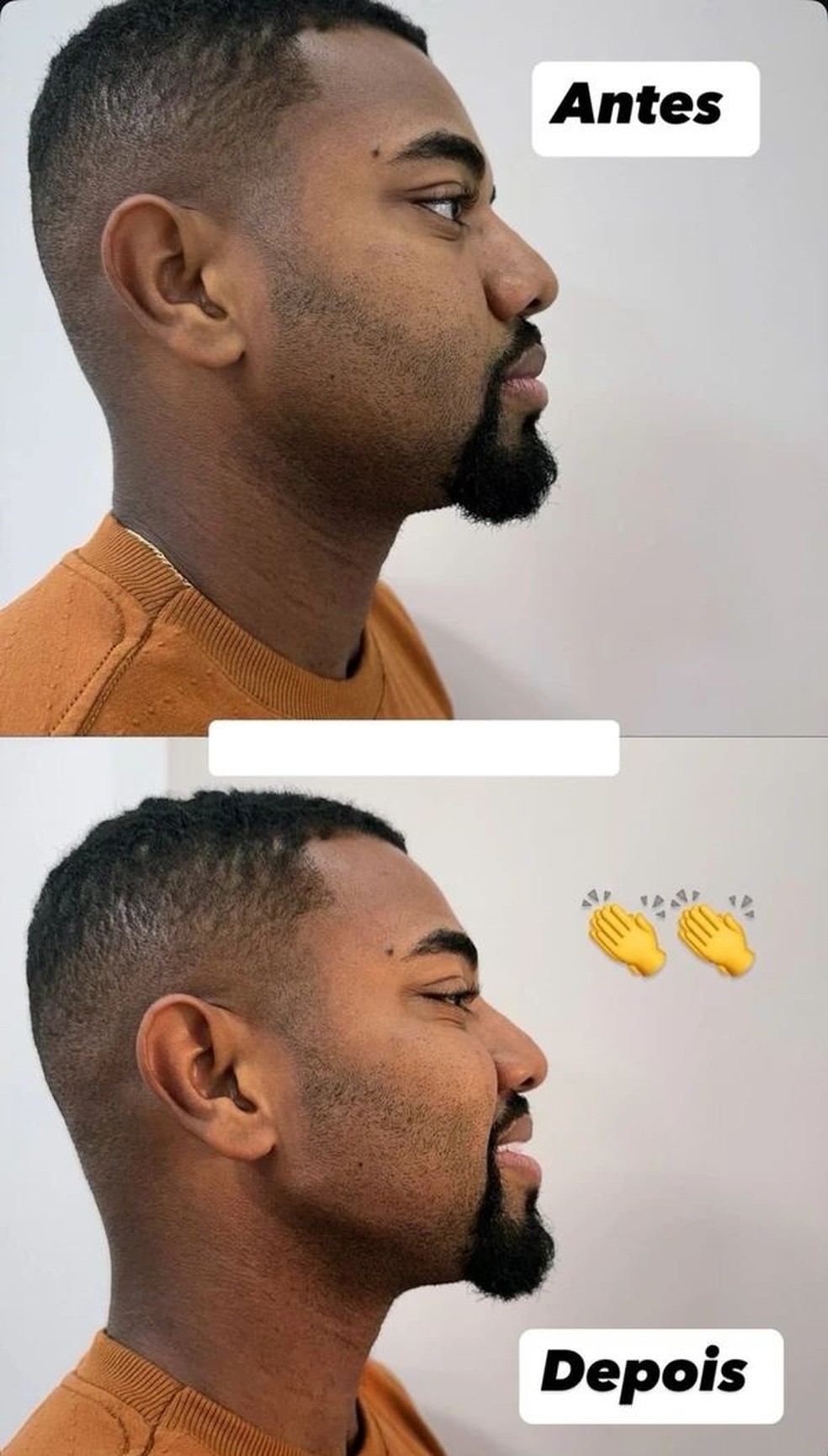 Davi Brito mostra o antes e depois da harmonização facial — Foto: Instagram