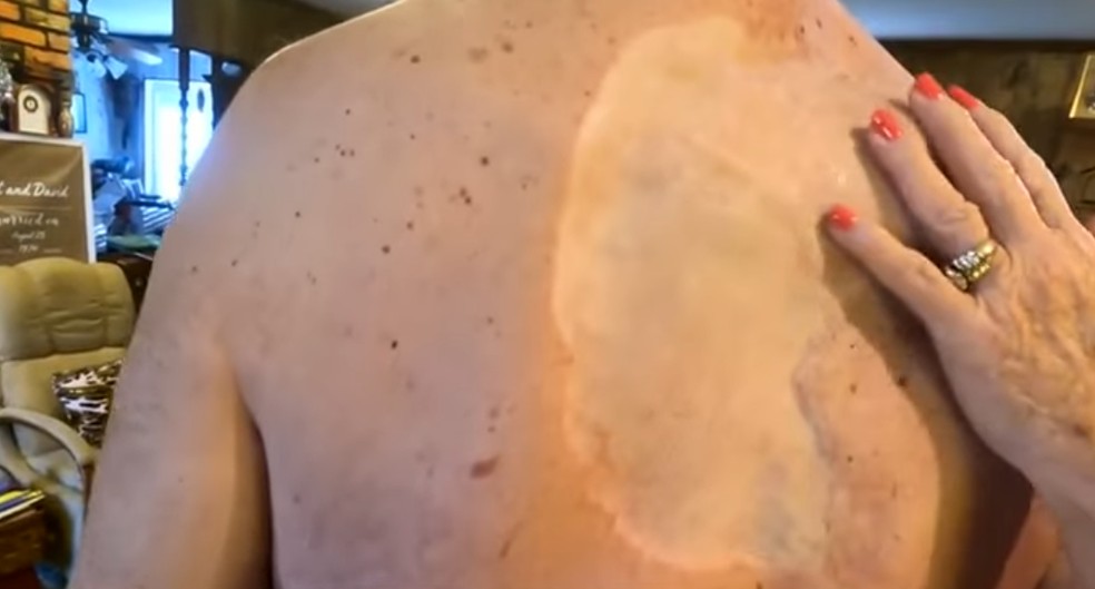 David mostra cicatrizes deixadas por uma das cirurgias — Foto: Reprodução/WRAL