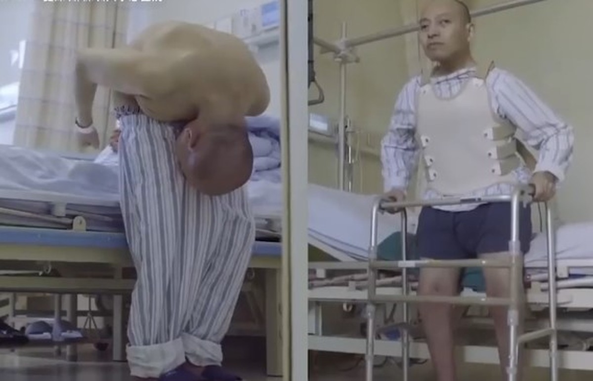 Graças a cirurgia, 'Homem Dobrado' consegue ficar ereto e ter 'vida ...