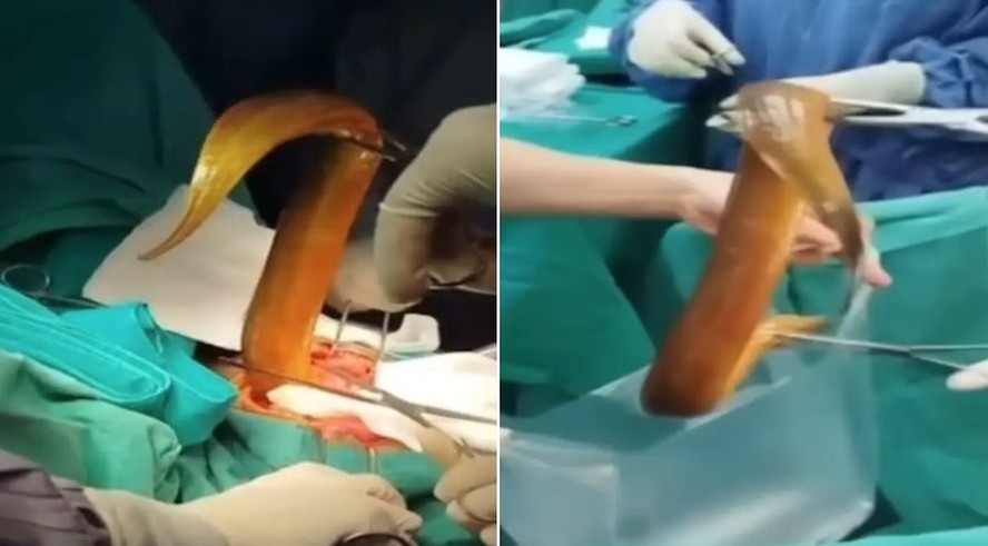 Médicos fazem cirurgia para retirar enguia viva de 60cm e limão do corpo de  paciente