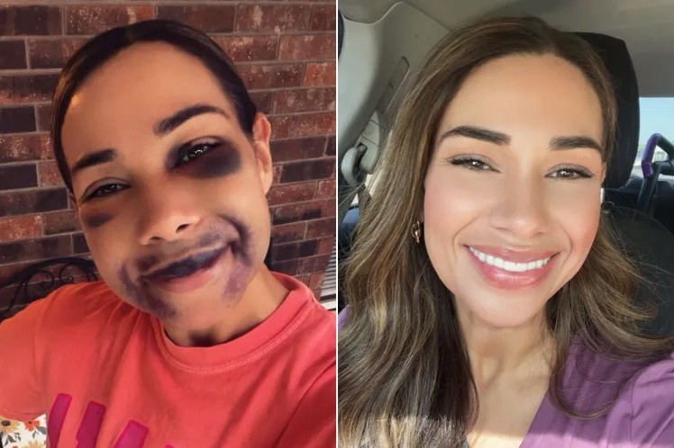 Mulher impressiona com múltiplos hematomas após implantes dentários