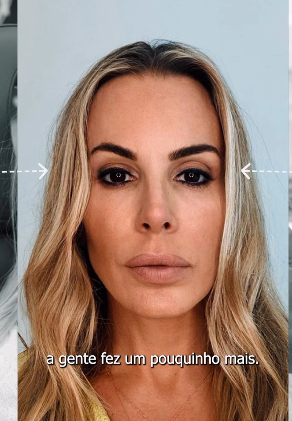 Ex-Feiticeira, Joana Prado faz harmonização facial — Foto: Instagram