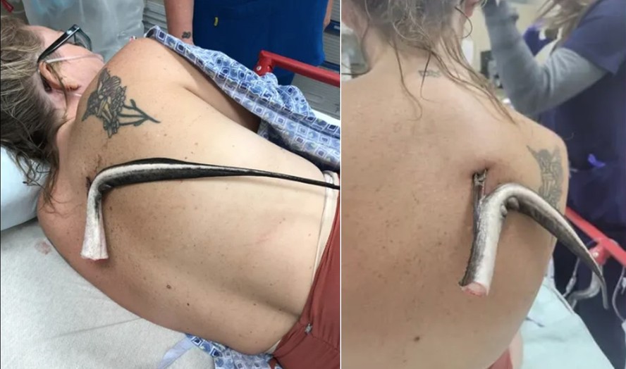 Banhista fica com ferrão de arraia cravado nas costas após entrar no mar da Flórida