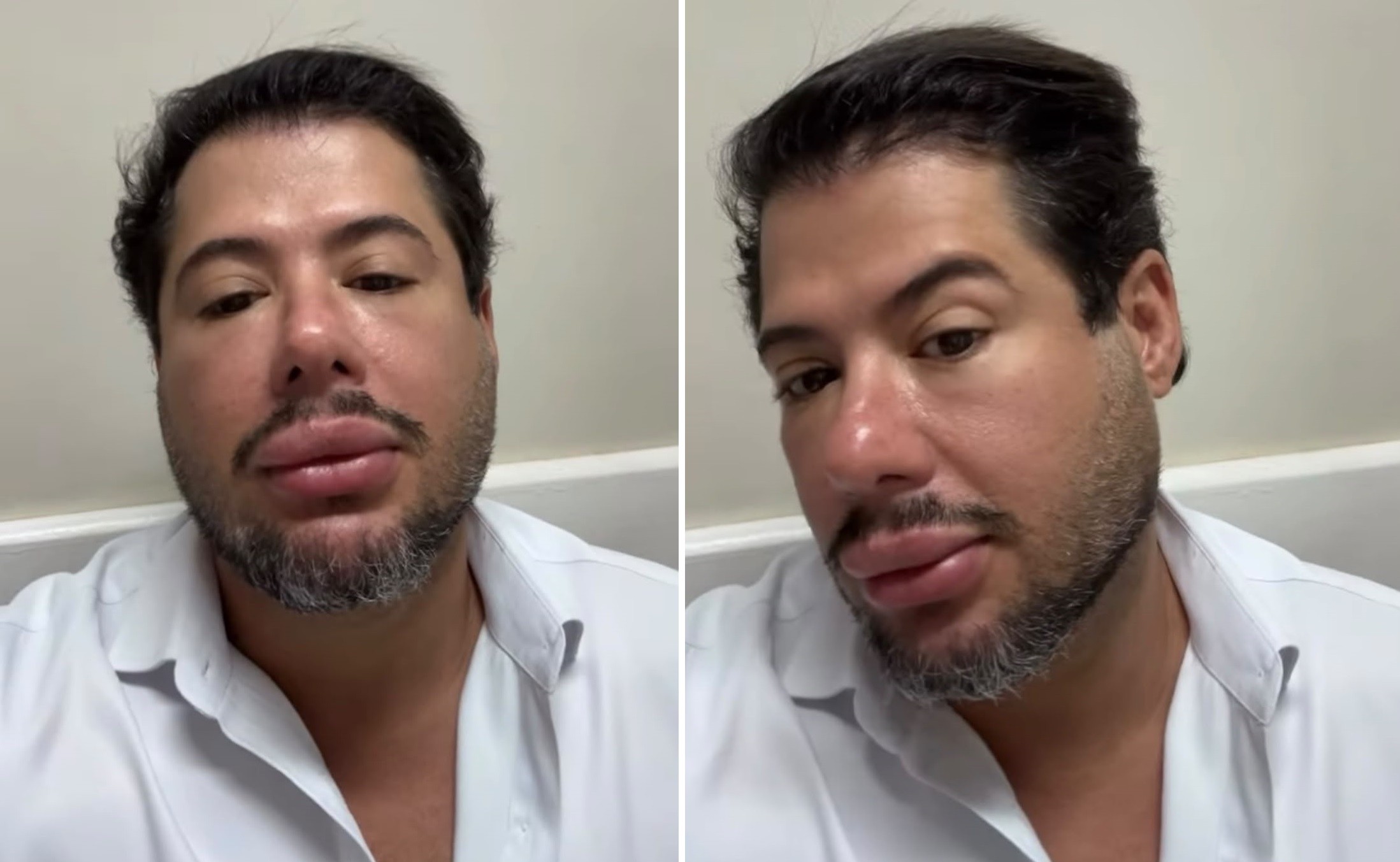Sertanejo Hugo chama atenção com rosto inchado após nova harmonização