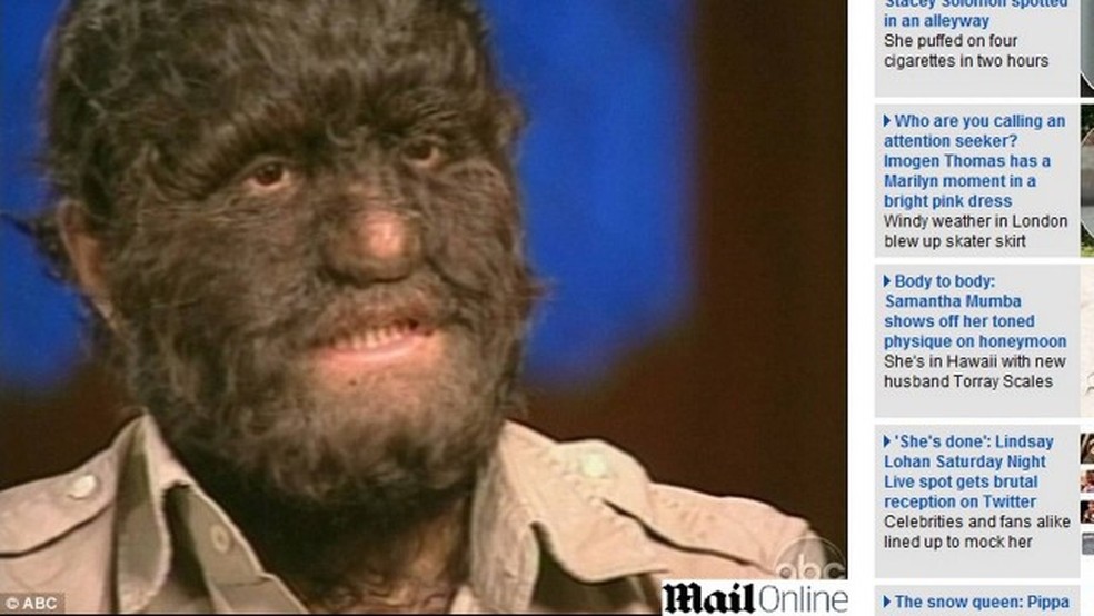 Realeza malaia batiza menina com ‘síndrome de lobisomem’ de ‘criança do