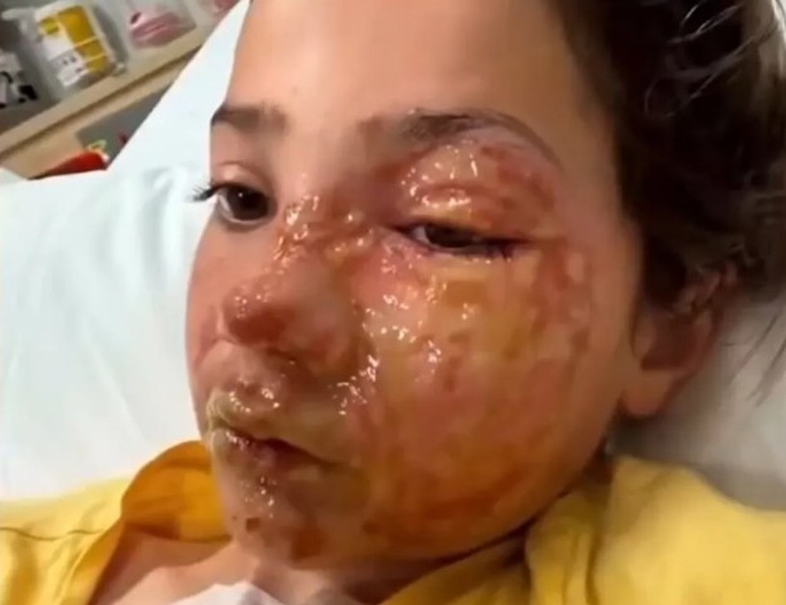 Violet ficou com queimaduras no rosto ap&oacute;s participar de desafio viral
