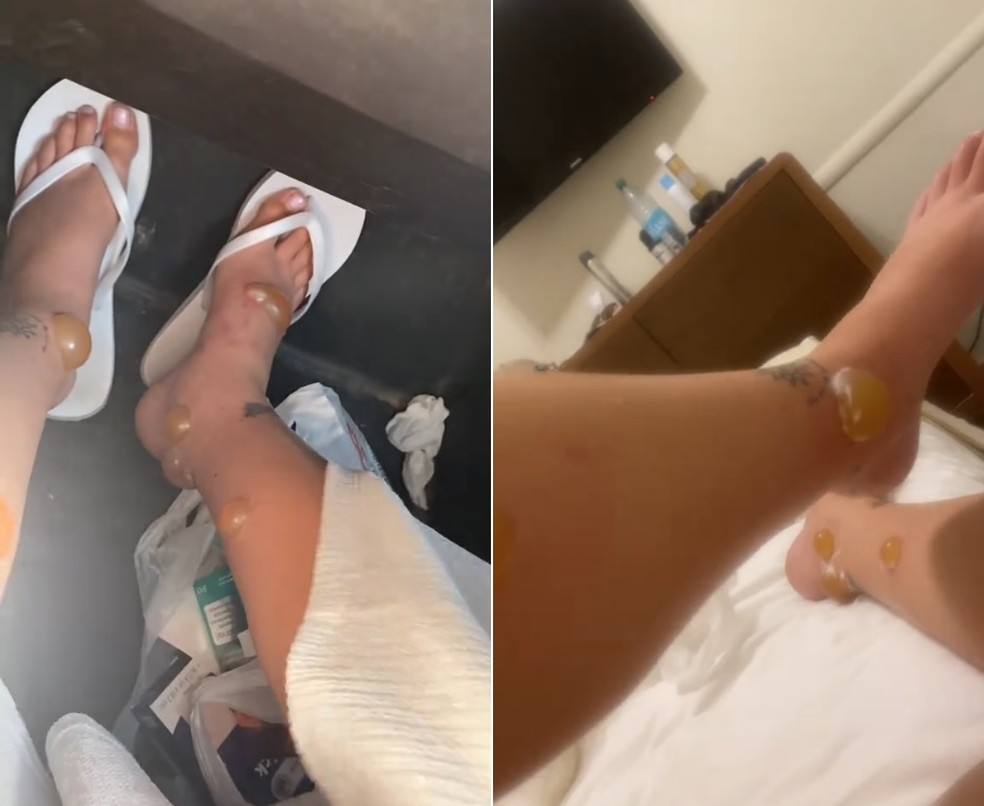 Mulher viraliza com impressionante reação a picadas de insetos durante lua de mel — Foto: Reprodução/TikTok