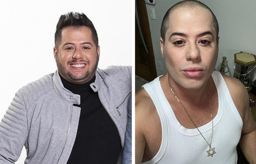 Sertanejo Hugo, da dupla com Tiago, surge bem diferente após harmonização e lipo — Foto: Instagram