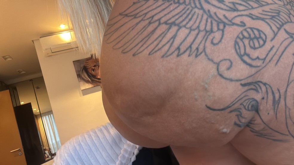 Juju Ferrari mostra como ficou o bumbum após infecção por hidrogel — Foto: Arquivo pessoal