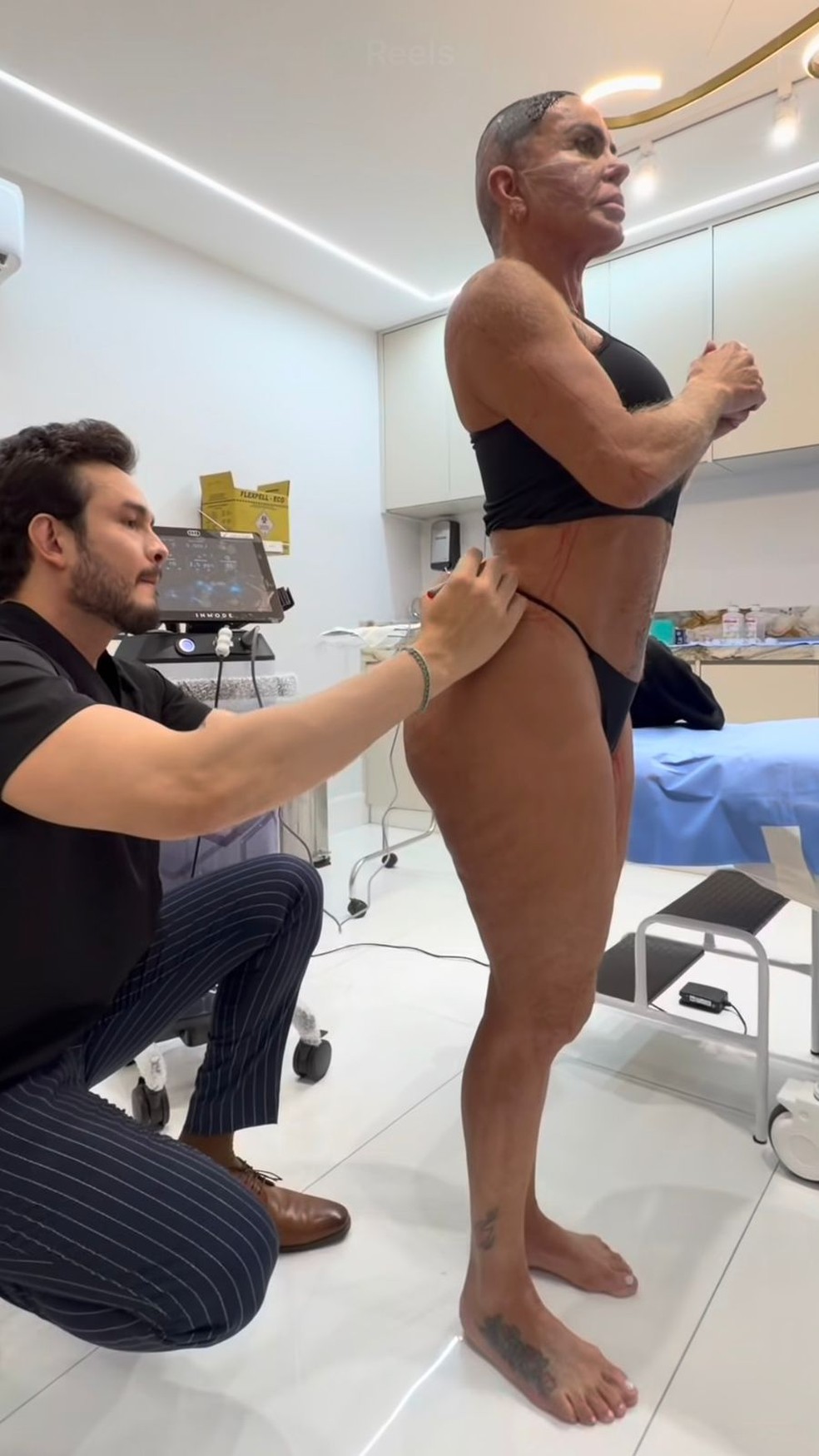 Gretchen faz tratamento contra flacidez no rosto, pernas e bumbum � Foto: Reprodu��o/Instagram