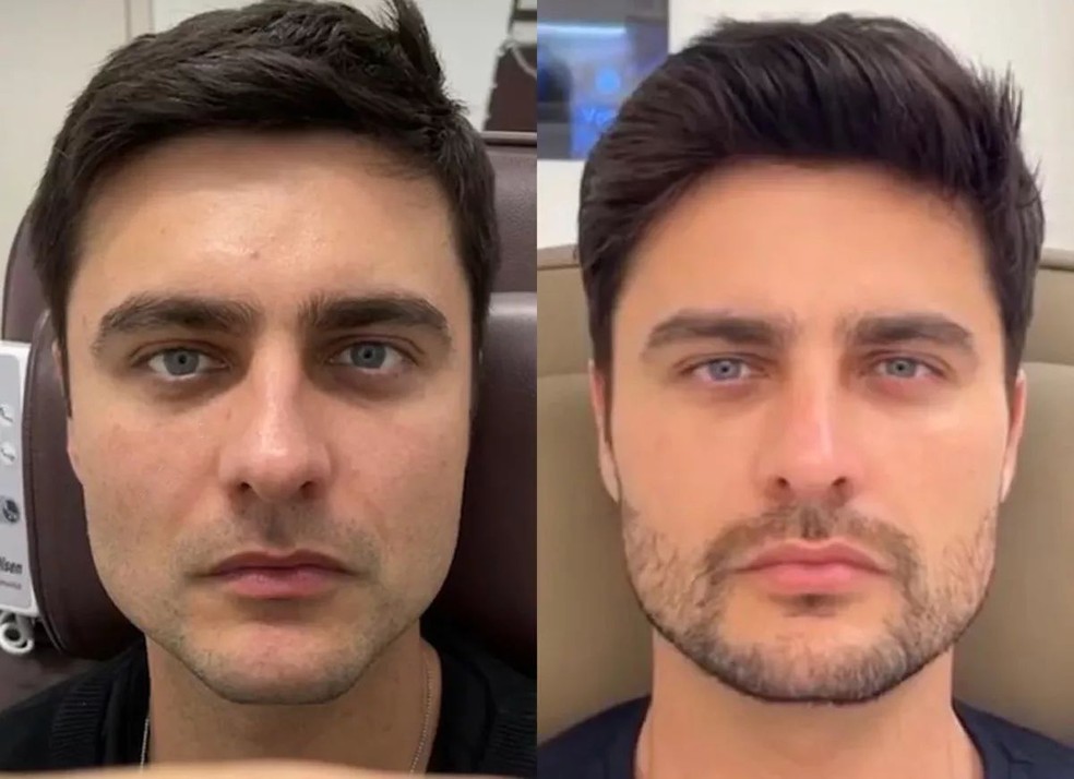 Guilherme Leicam antes e depois da harmonização facial feita em 2021 — Foto: Divulgação