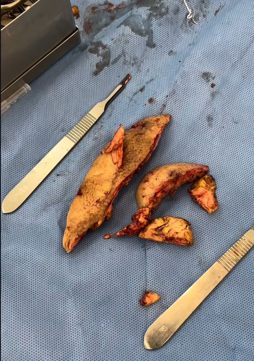 m&eacute;dico mostra &oacute;leo mineral enrijecido retirado do rosto de Juju do Pix &mdash; Foto: Reprodu&ccedil;&atilde;o/Instagram