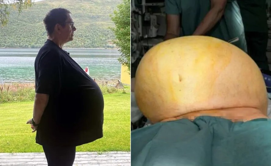Tratado por 'obesidade', Thomas Kraut tinha na verdade tumor de 27 quilos na barriga
