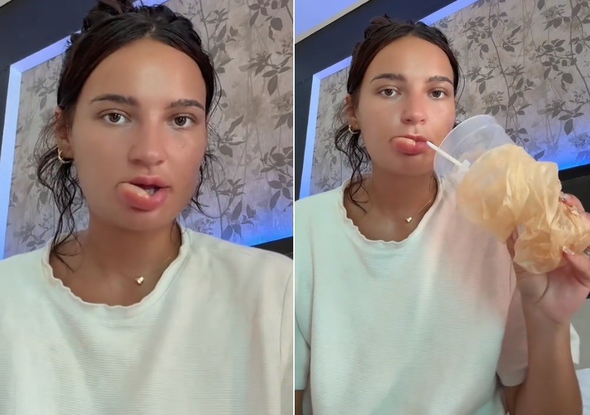 Influencer fica com lábio deformado ao 'mastigá-lo' quando dormia - Foto