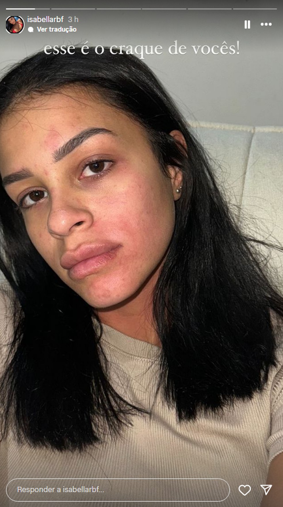 Isabella publicou fotos do rosto machucado nas redes sociais — Foto: Reprodução