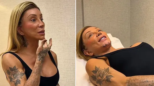 Maya Massafera passa por nova intervenção estética para refinar o contorno facial