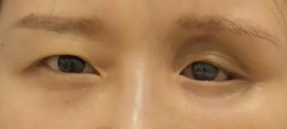 Paciente chinesa tinha cinco lentes 'perdidas' no olho esquerdo &mdash; Foto: Reprodu&ccedil;&atilde;o/Wolters Kluwer Health