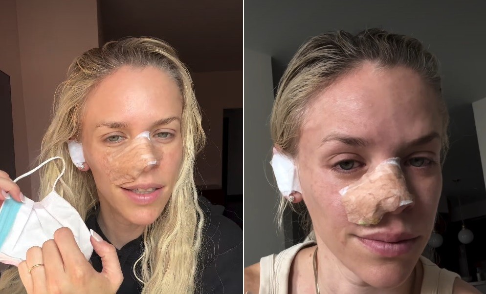 Apresentadora de TV tira parte de orelha para reconstruir o nariz após remover câncer que 'parecia espinha'