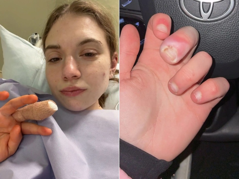 Gabby Swierzewski quase perdeu dedo por causa de v&iacute;cio em roer as unhas &mdash; Foto: Reprodu&ccedil;&atilde;o