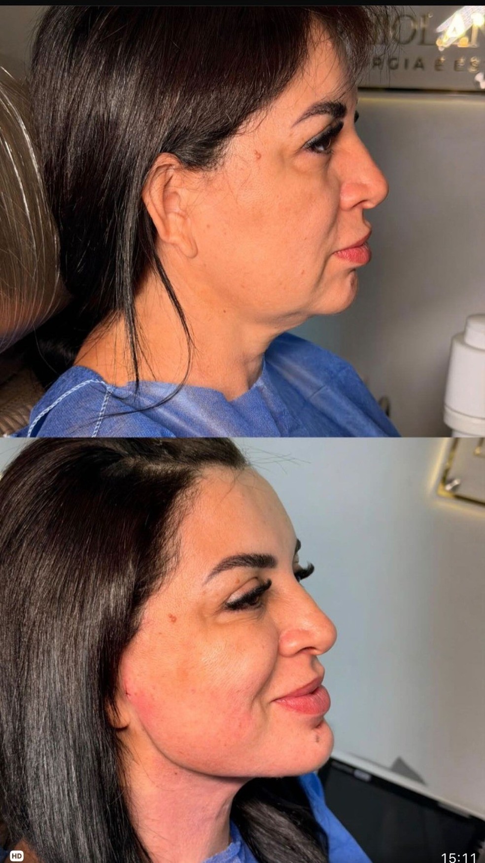 Kátia Gomes: antes e depois da lipo de papada — Foto: rep/ instagram