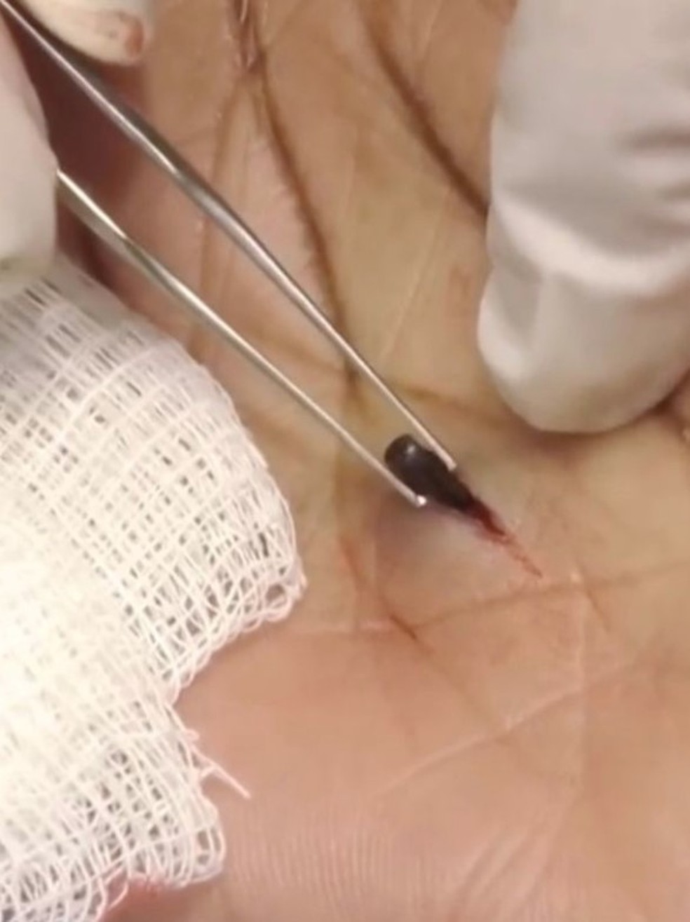 Mulher tem ponta de l&aacute;pis removida de m&atilde;o ap&oacute;s 45 anos por Sandra Lee &mdash; Foto: Reprodu&ccedil;&atilde;o