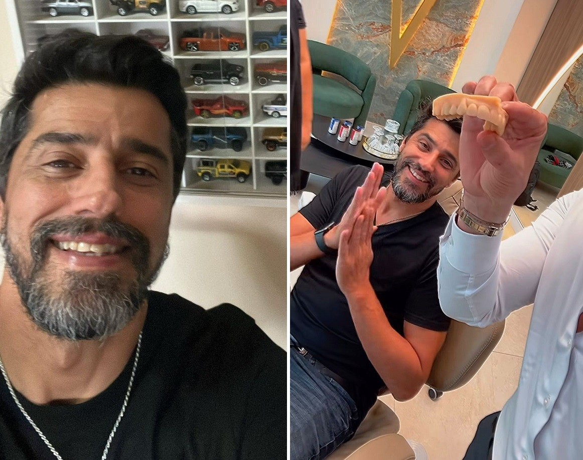 Ex-BBB Alberto Cowboy adere lentes de contato nos dentes e exibe novo sorriso; confira!