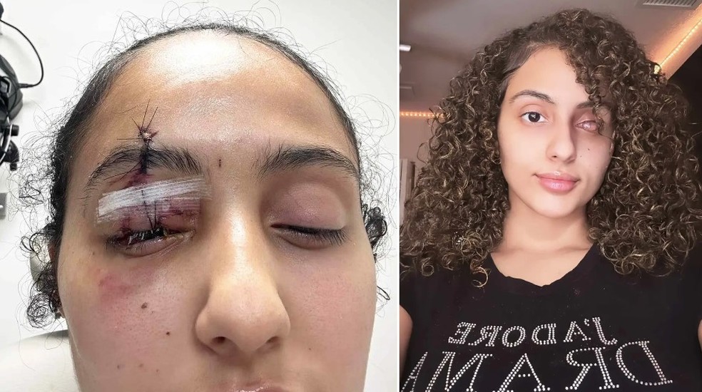 Daniella Abreu teve um olho removido após acidente com guia retrátil para cães — Foto: Reprodução