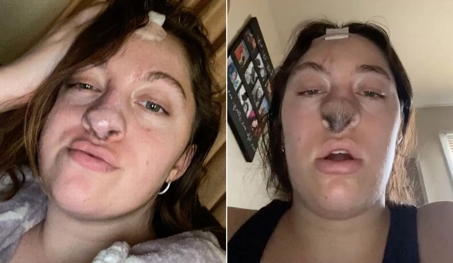 Trinity Rowles: pelos crescendo no nariz ap&oacute;s receber enxerto de pele