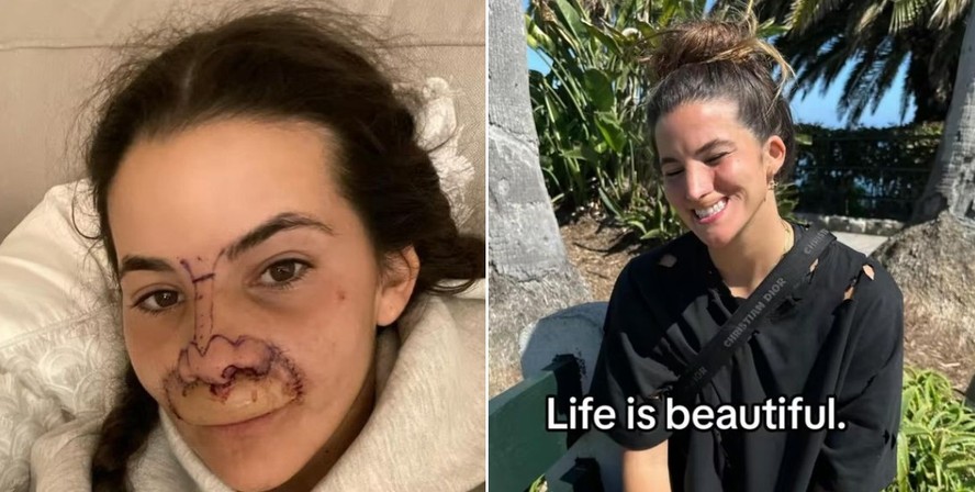Modelo que teve lábio e parte do nariz arrancados por pitbull comemora a recuperação: 'A vida é bonita'
