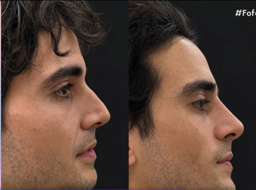 Fiuk passa por harmonização facial: antes e depois — Foto: divulgação/ sbt