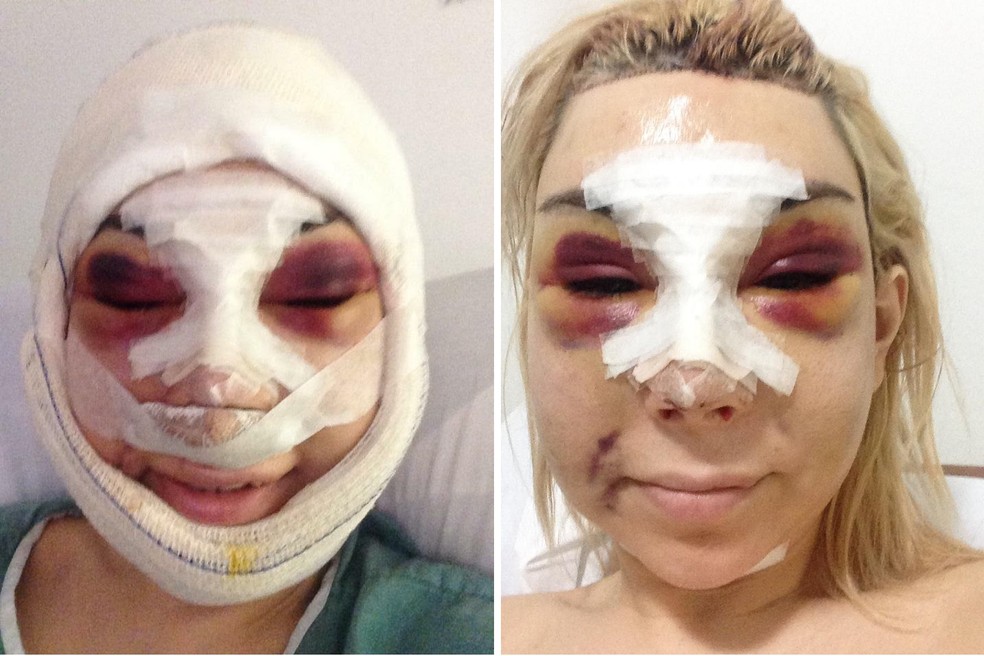 Cantora trans portuguesa Patrícia Ribeiro se arrepende de silicone industrial — Foto: Arquivo pessoal