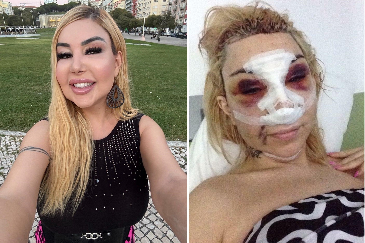 Cantora trans portuguesa se arrepende de ter usado silicone industrial: ‘Meu rosto teve que ser deslocado’