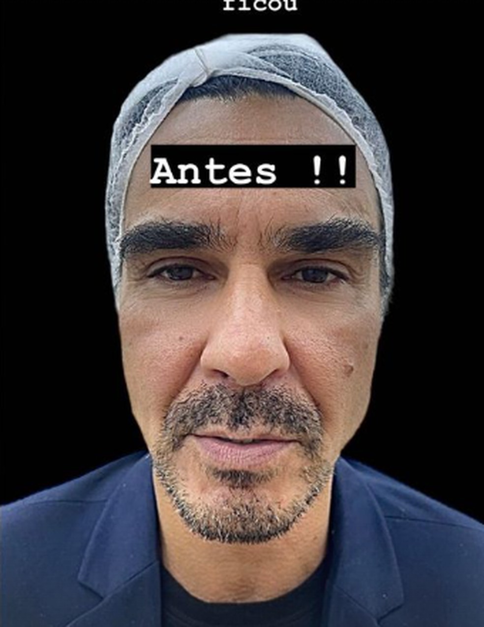 André Gonçalves antes de fazer harmonização facial — Foto: Reprodução/Instagram