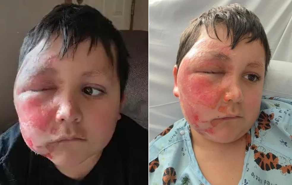 Menino fica com o rosto deformado ap&oacute;s participar de desafio popular no TikTok &mdash; Foto: Reprodu&ccedil;&atilde;o/Loyola Medicine