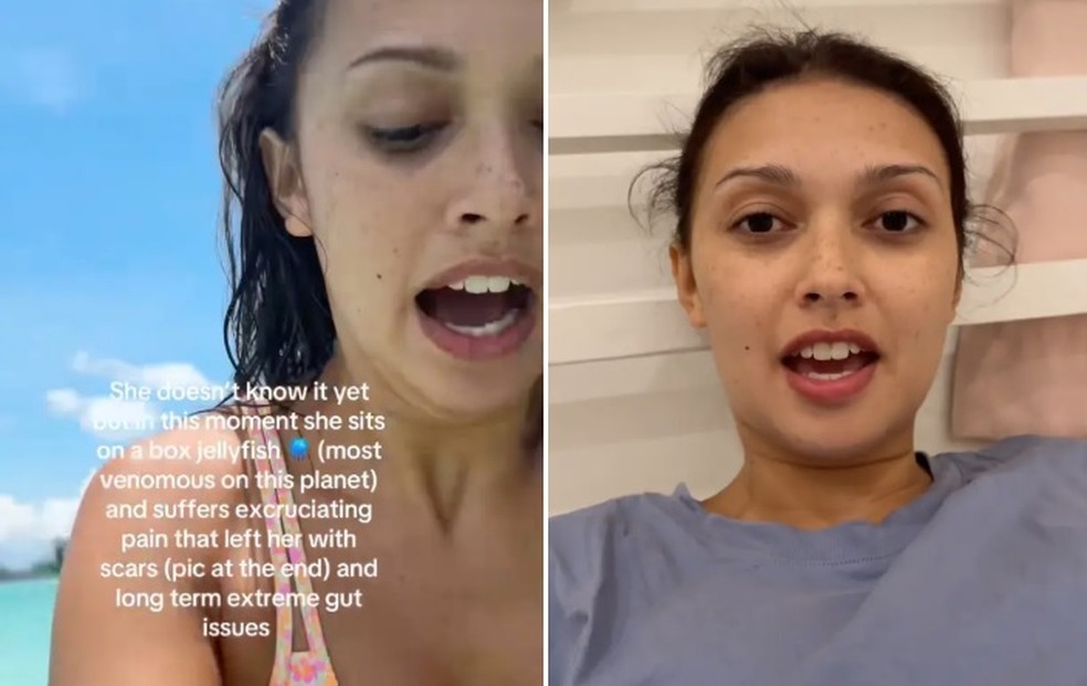 Julie no momento em que foi picada por água-viva (à esquerda) e, posteriormente, em hospital — Foto: Reprodução/TikTok