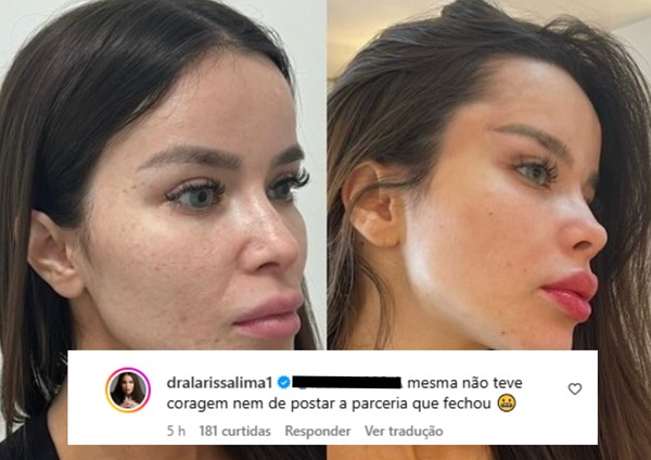 Acusada de usar photoshop, Bianca Anchieta faz harmonização e médica