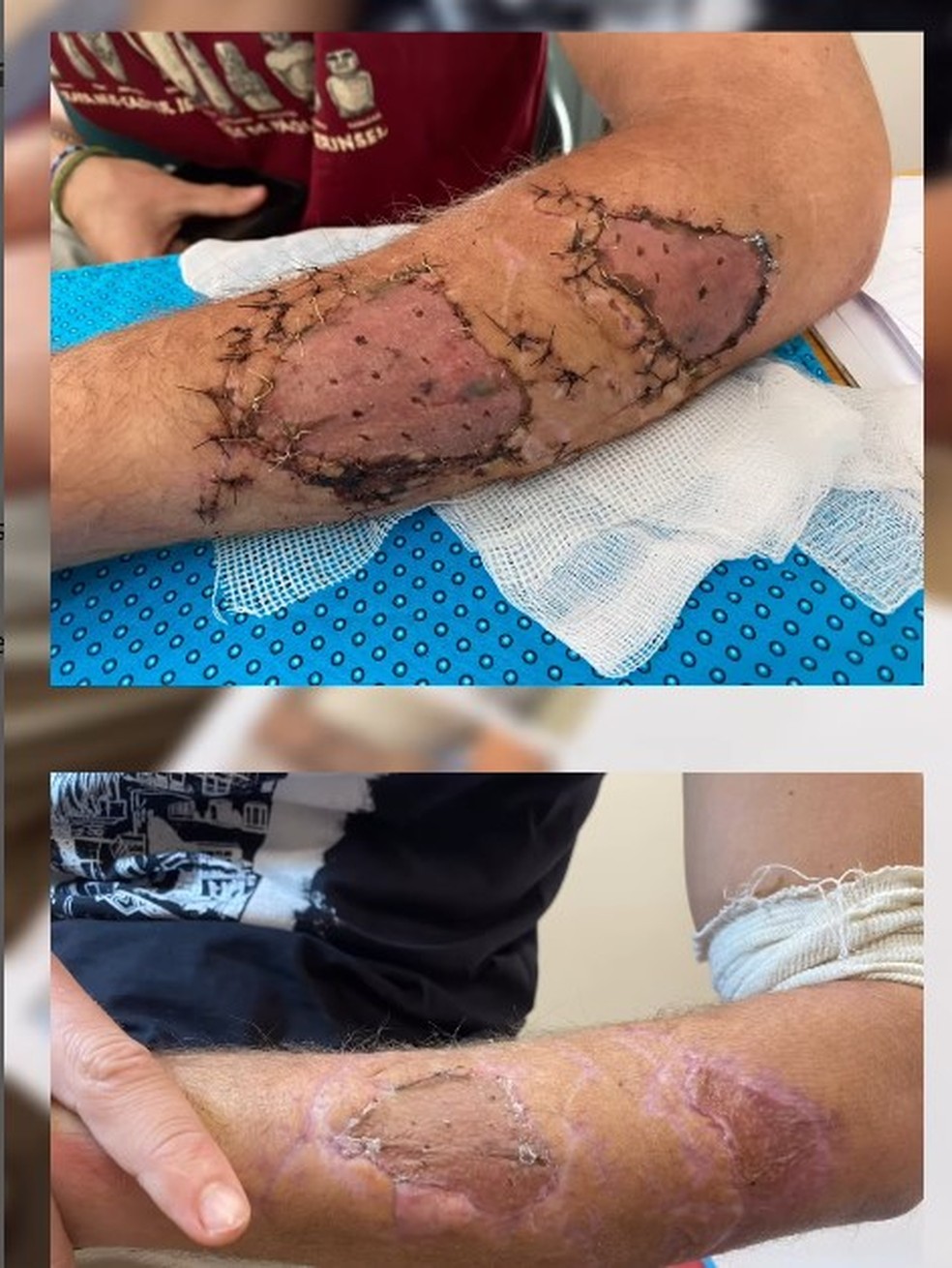 A recuperação de Angus Kockott após ataque de tubarão na Polinésia Francesa — Foto: Reprodução/Instagram