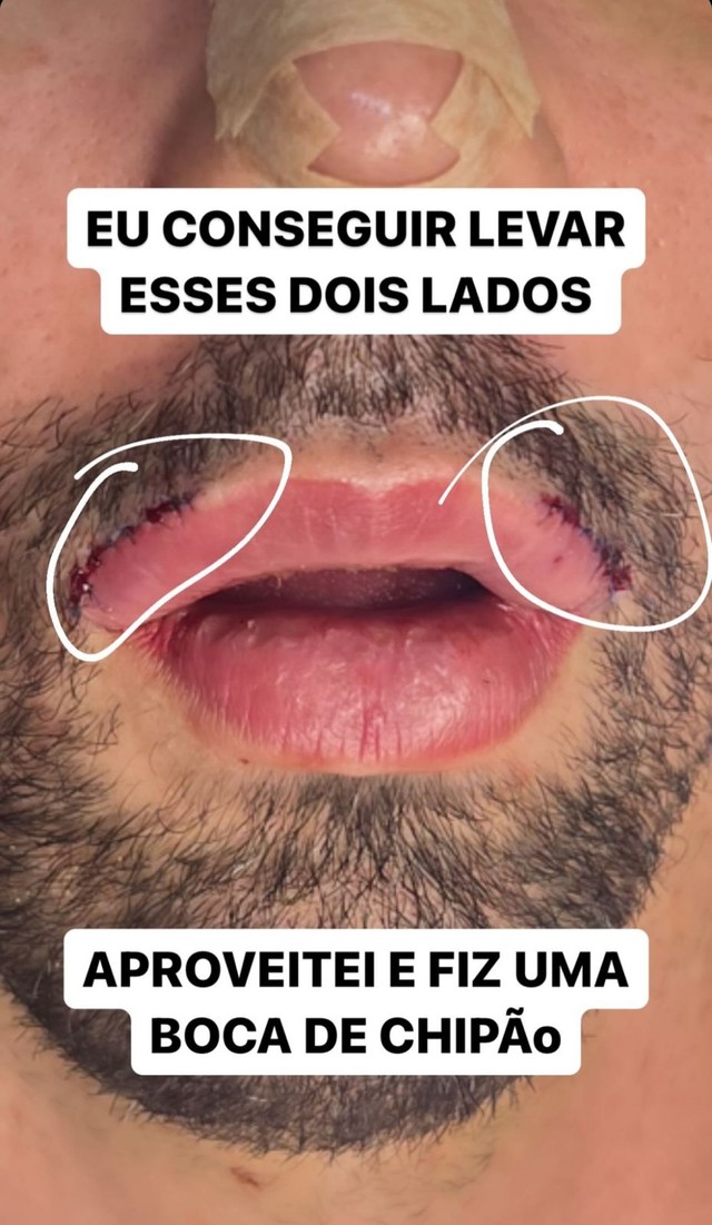 Rico Melquíades desabafa após cinco cirurgias no rosto: 'Fiquei mal com ...